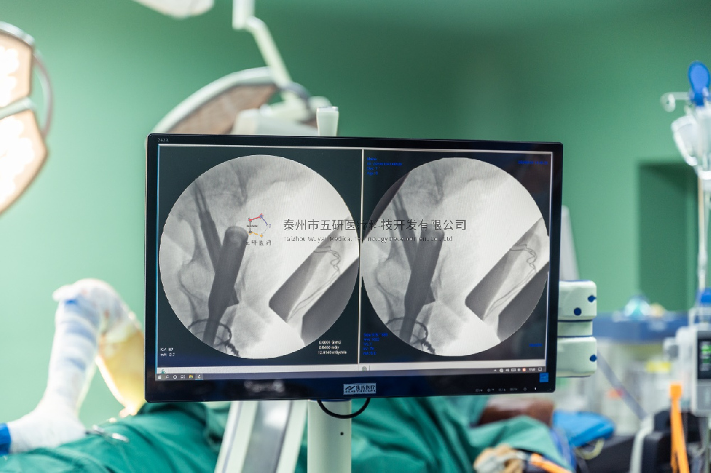 強(qiáng)直性脊柱炎既往病史，股骨粗隆下骨折